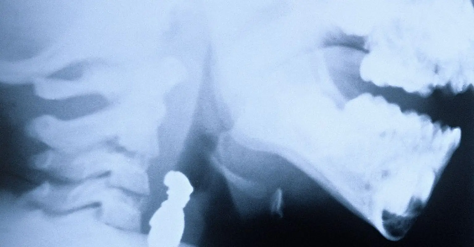 Doctors successfully reattach boy's head after he was decapitated