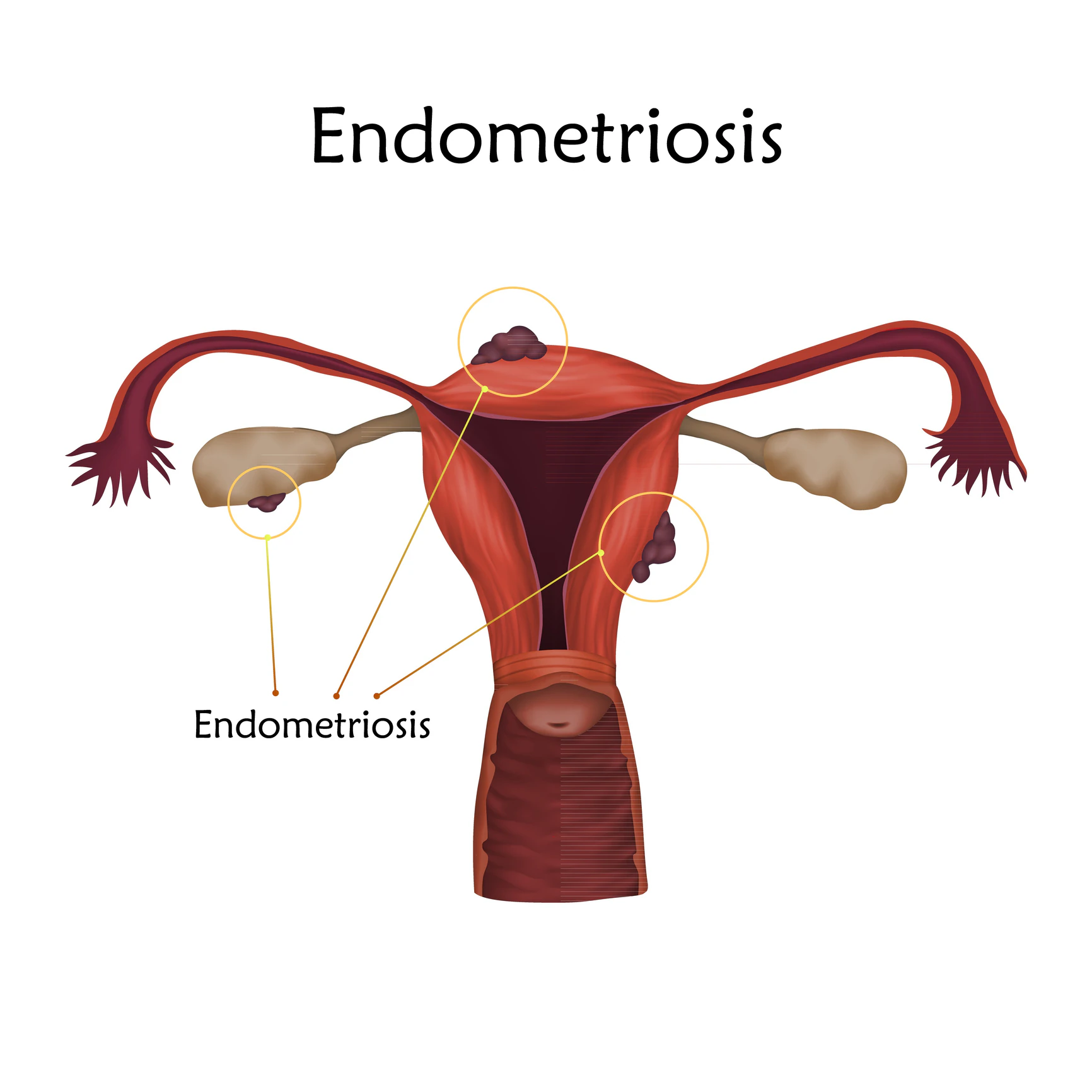 Endometriosis