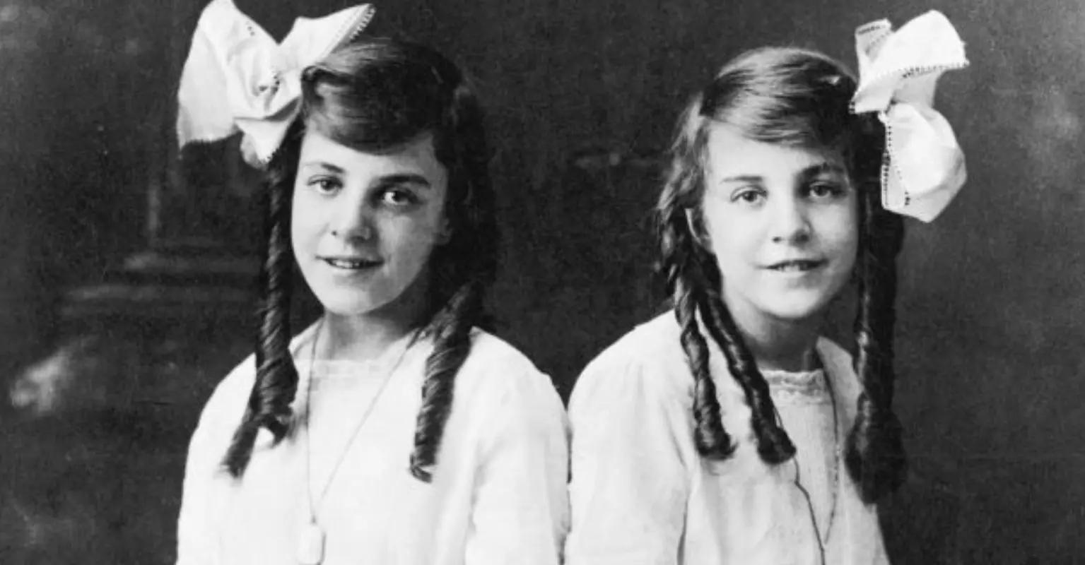 Disturbing case of conjoined twin forced to live with sister's dead body attached to her for days