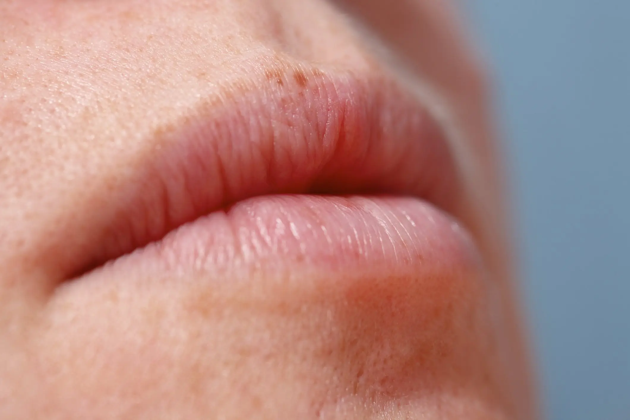 Fordyce Spots can appear on the lips. Credit: Julian Ward / Getty