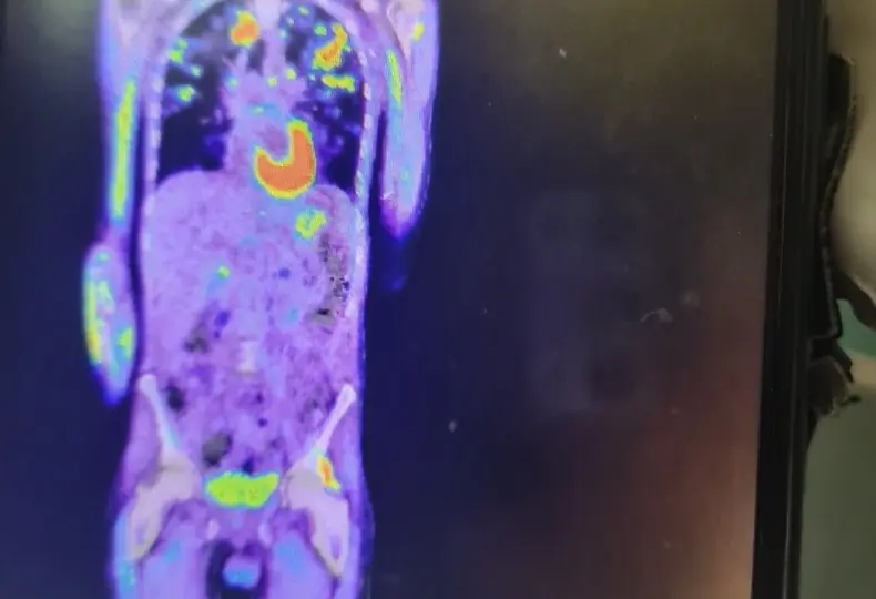 The infection can be seen spreading through his body. Credit: GoFundMe