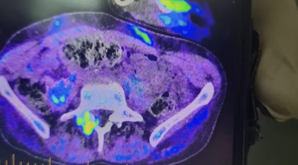 Capper shared photos of how the disease is impacting his body. Credit: GoFundMe