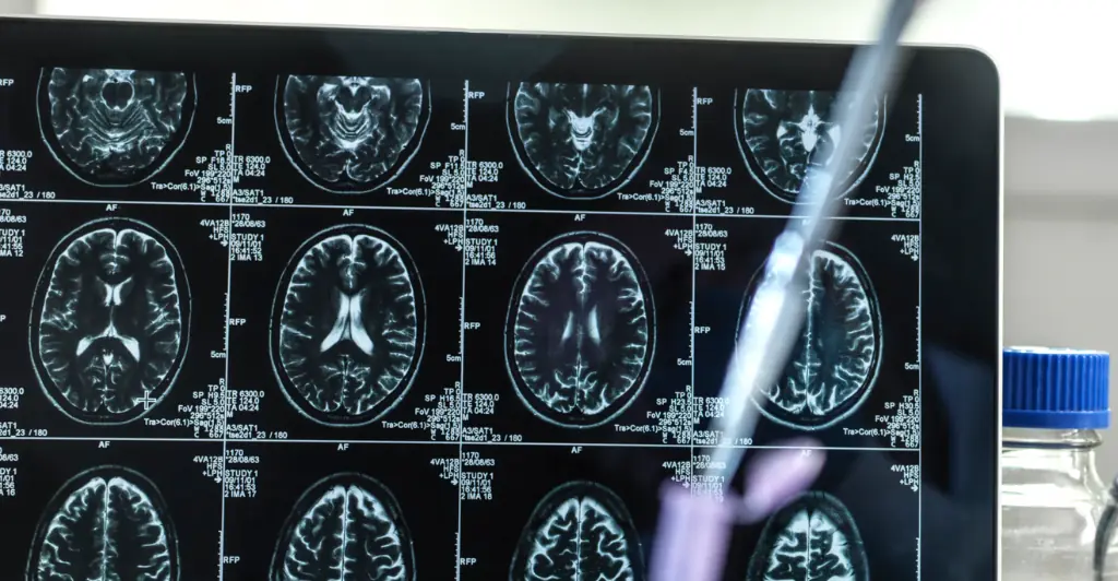 Scientists discover that Alzheimer's can be passed from person to person in groundbreaking study