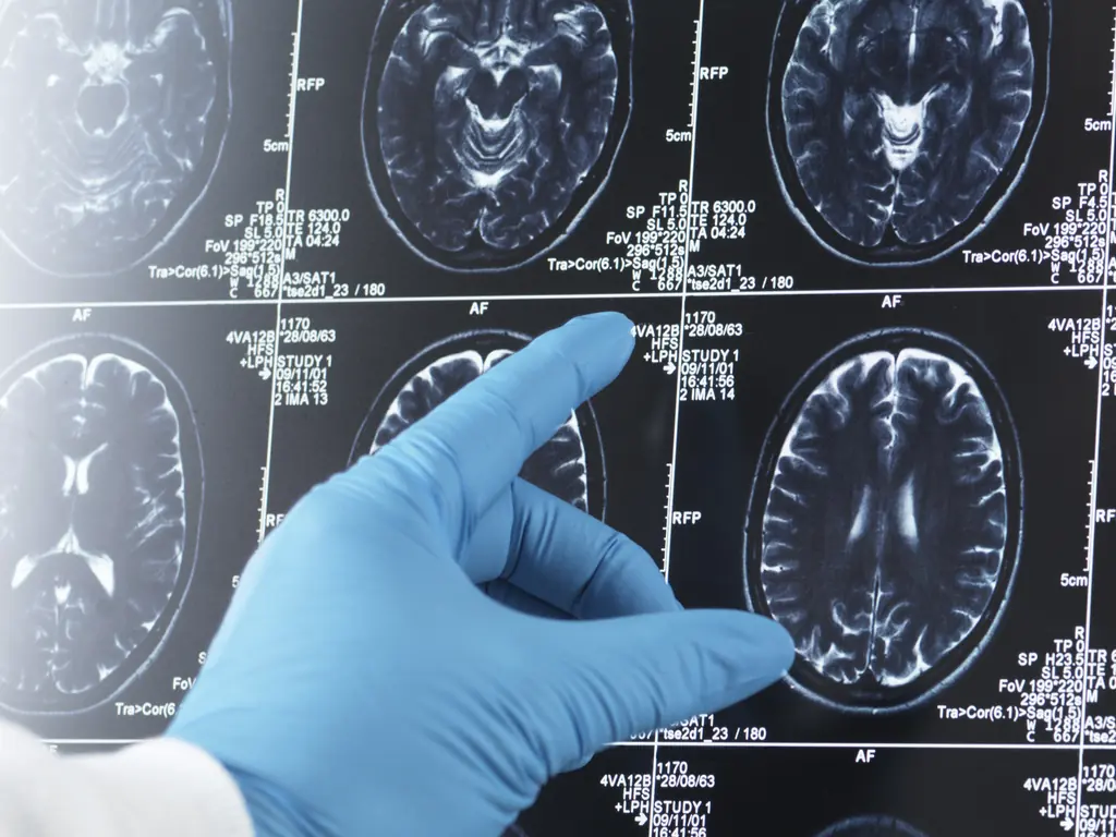 Mom stunned to find out a facial feature she thought her baby inherited from dad is actually a sign of childhood dementia