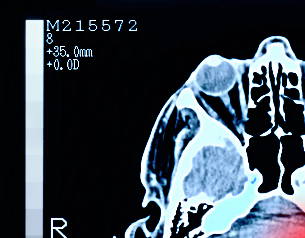 Headaches are a major sign of brain cancer. Credit: Peter Dazeley / Getty