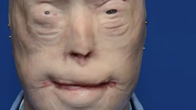 Patrick Hardison before his surgery. Credit: NYU Langone Medical Center