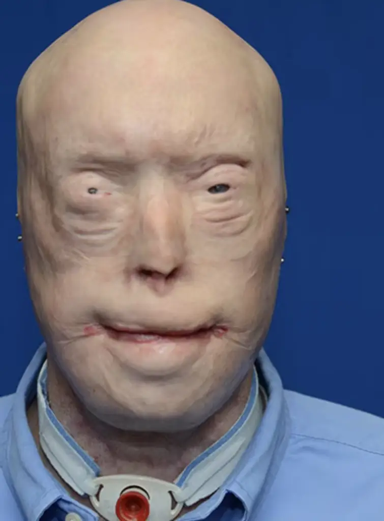 Patrick Hardison before his surgery. Credit: NYU Langone Medical Center