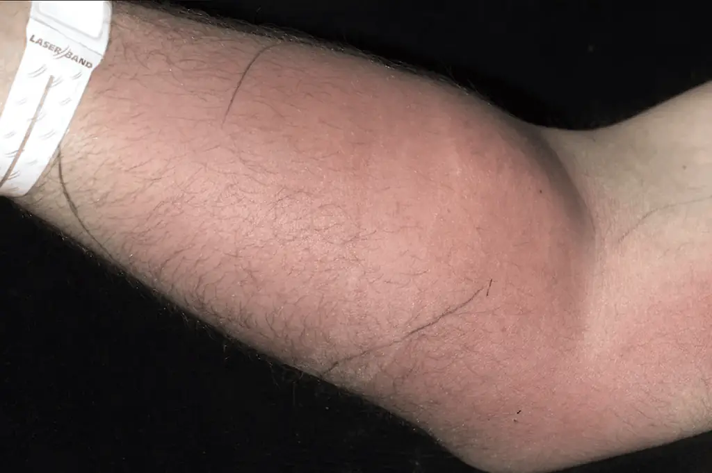The man injected himself with his own sperm to remedy his back pain. Credit: Irish Medical Journal