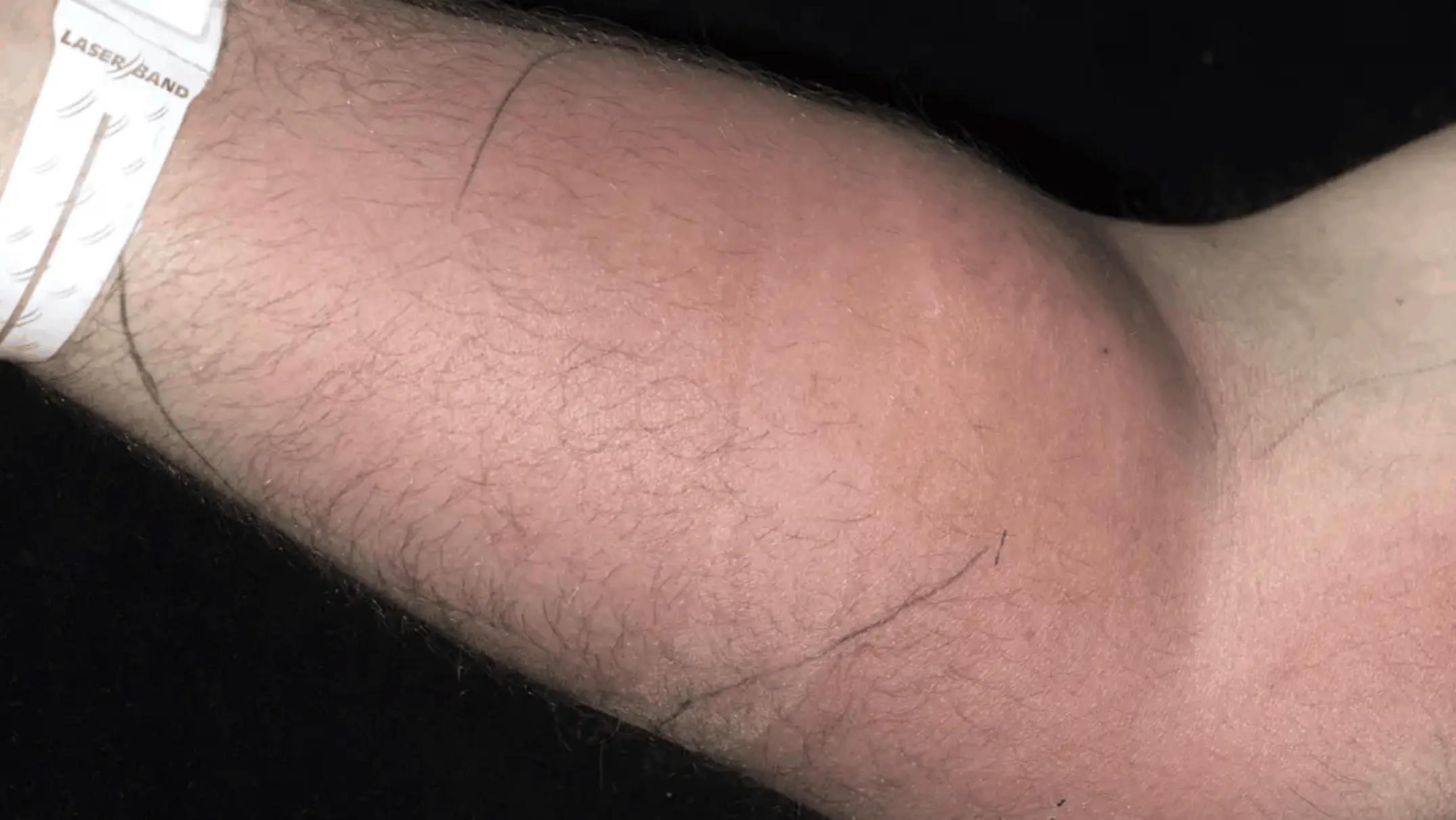 The man injected himself with his own sperm to remedy his back pain. Credit: Irish Medical Journal