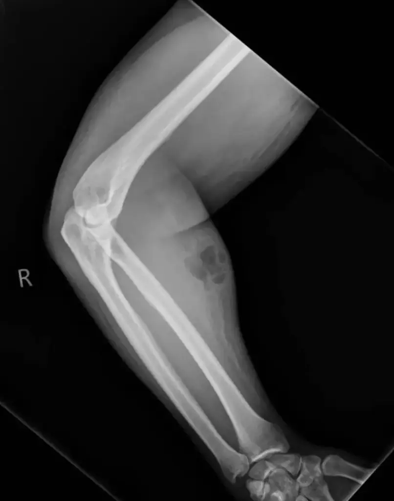 An X-ray revealed how swollen the man's arm was from the semen. Credit: Irish Medical Journal