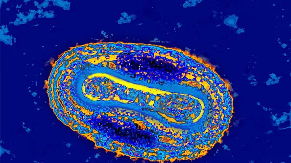 Virus Pneumonia