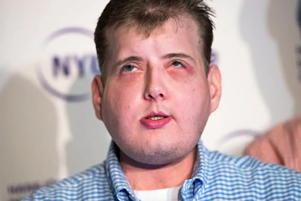 Patrick Hardison received life-changing surgery 10 years ago, but where is he now? Credit: Drew Angerer/Getty Images